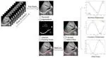 An optimized optical-flow-based method for quantitative tracking of ultrasound-guided right diaphragm deformation